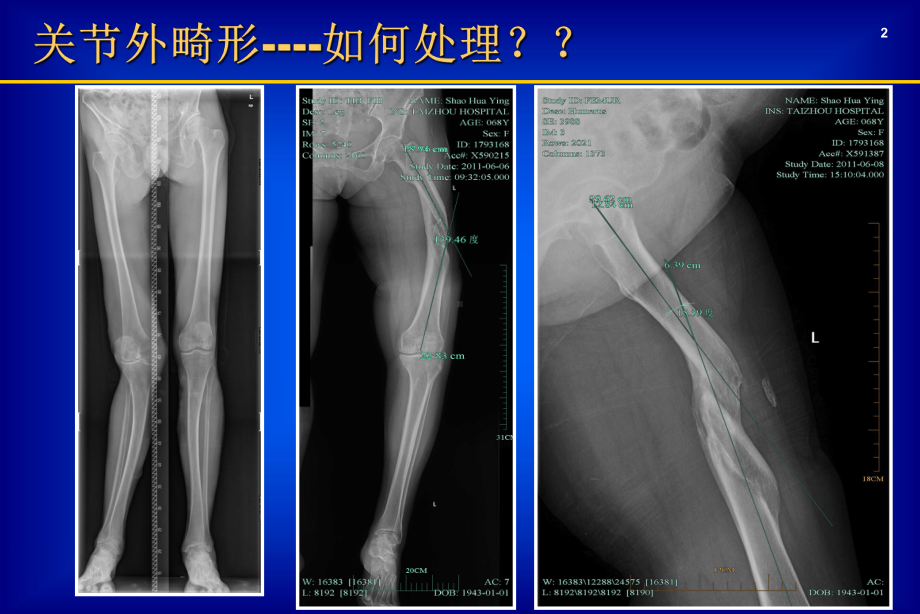 医学课件-关节外畸形全膝教学课件.ppt_第2页