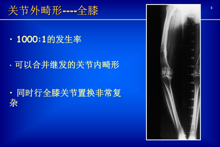 医学课件-关节外畸形全膝教学课件.ppt_第3页