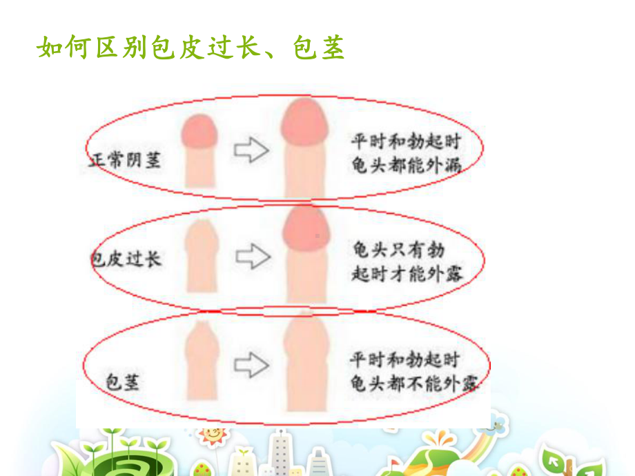 包茎、包皮过长护理课件.ppt_第3页