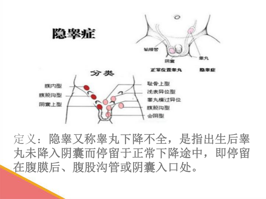 医学课件隐睾护理查房专题宣讲.ppt_第2页