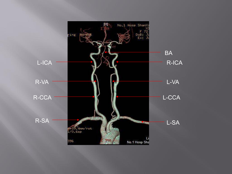 头颈部CTA与头颈部血管常见变异课件.ppt_第3页