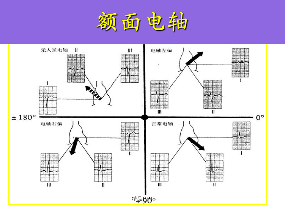 室性早搏、室性心动过速的体表心电图定位诊断课件.ppt_第3页