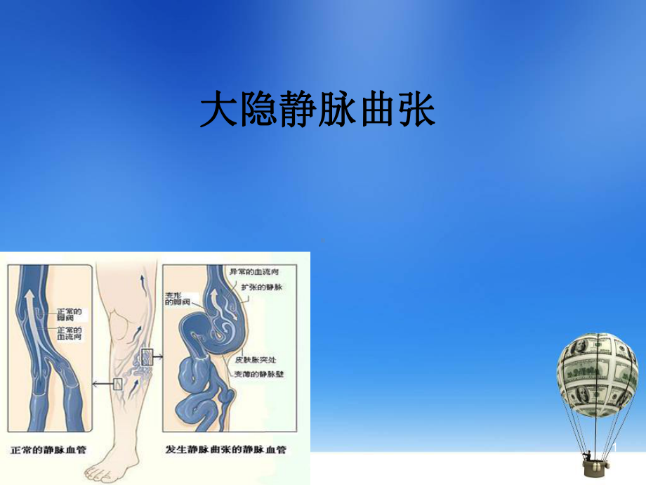 医学课件-大隐静脉曲张教学课件.ppt_第1页