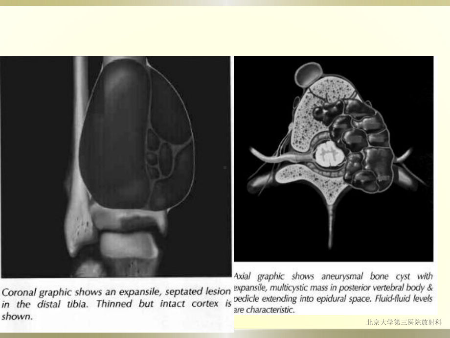 动脉瘤样骨囊肿医学课件.ppt_第3页