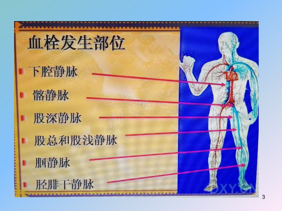 深静脉血栓的防治课件.ppt_第3页