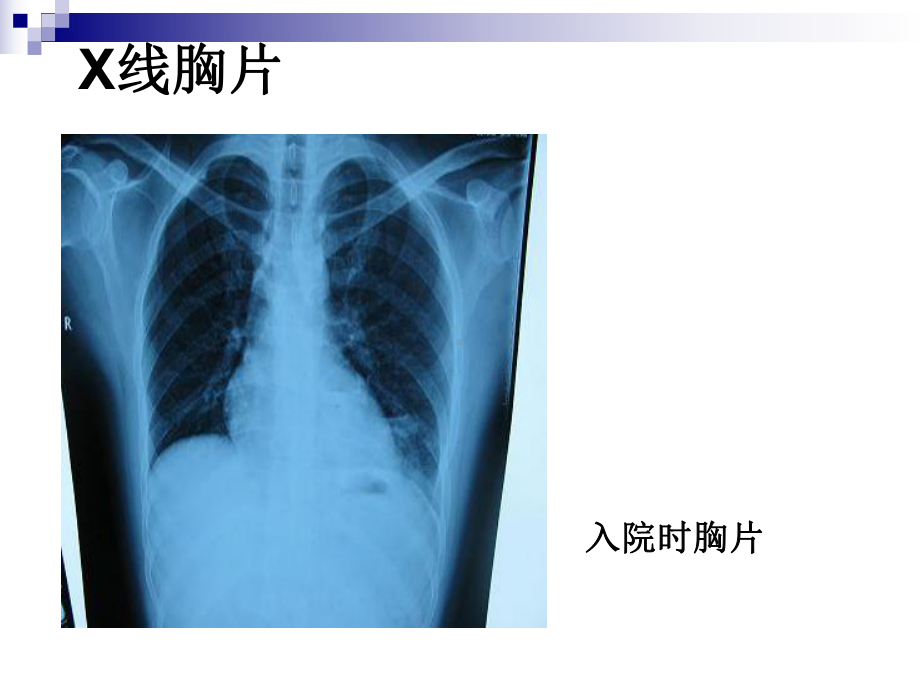 肺脓肿医学知识讲座优质课件.ppt_第2页