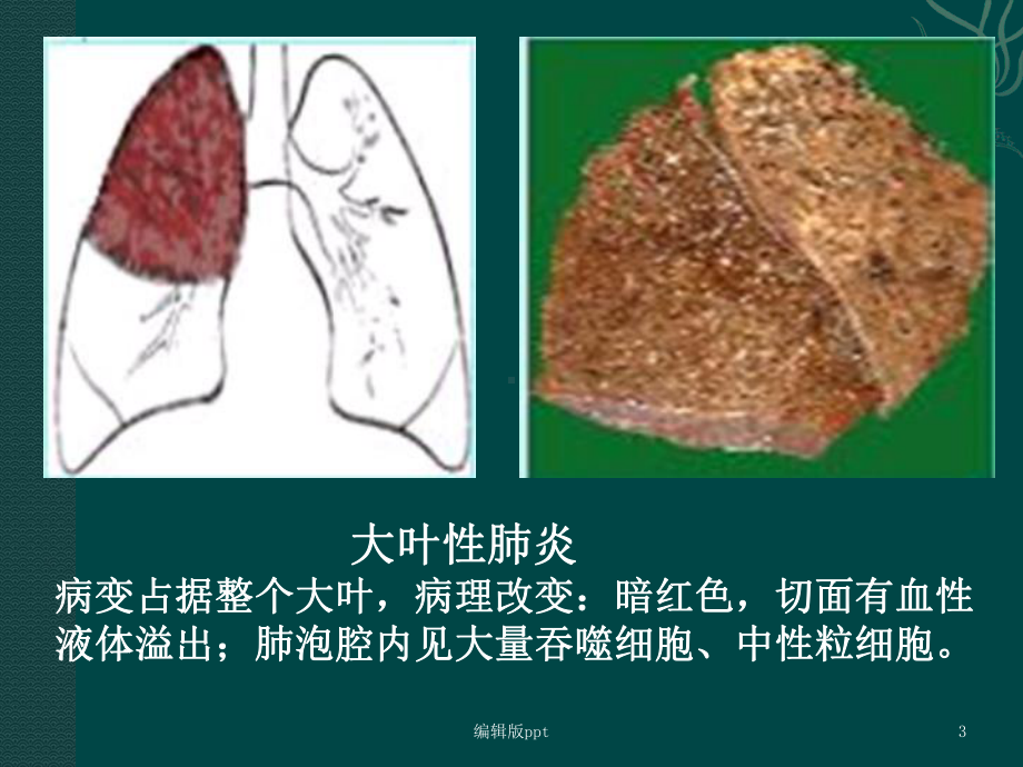 肺部感染课件.ppt_第3页