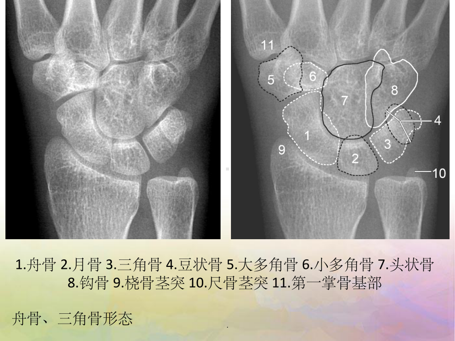 腕关节-解剖课件.ppt_第3页