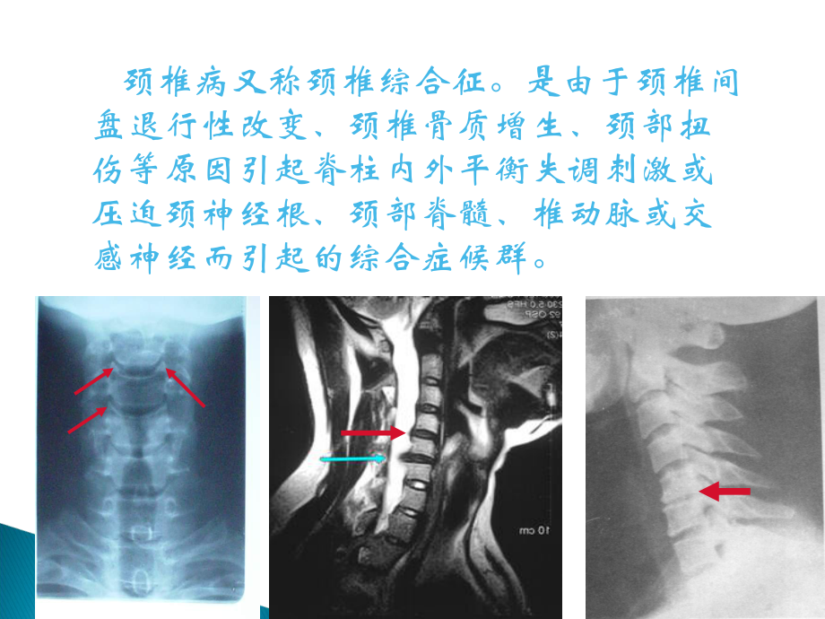 最新颈椎病科普讲座主题讲座课件.ppt_第3页