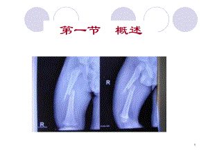 章-骨折病人的护理课件.ppt