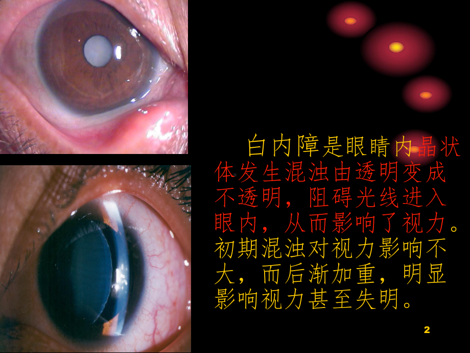 白内障教学讲解课件.ppt_第2页