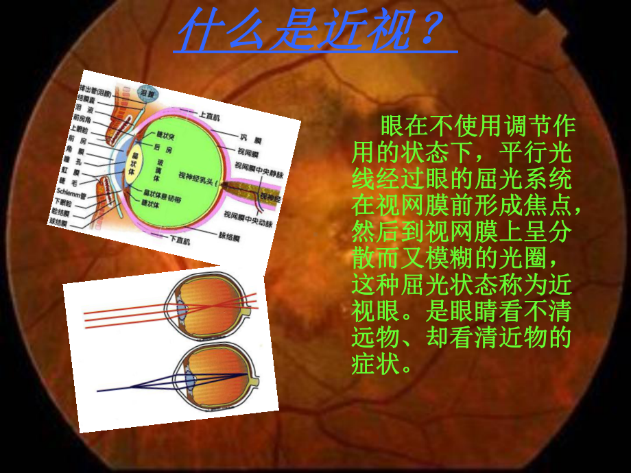 近视对我们的危害课件.ppt_第2页