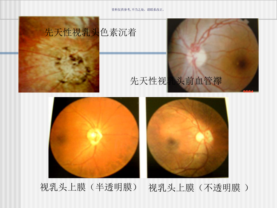 眼底病主题医学知识课件.ppt_第3页