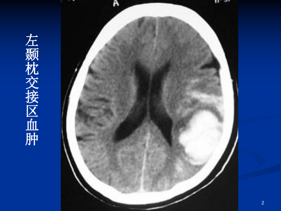 脑血管教学讲解课件.ppt_第2页