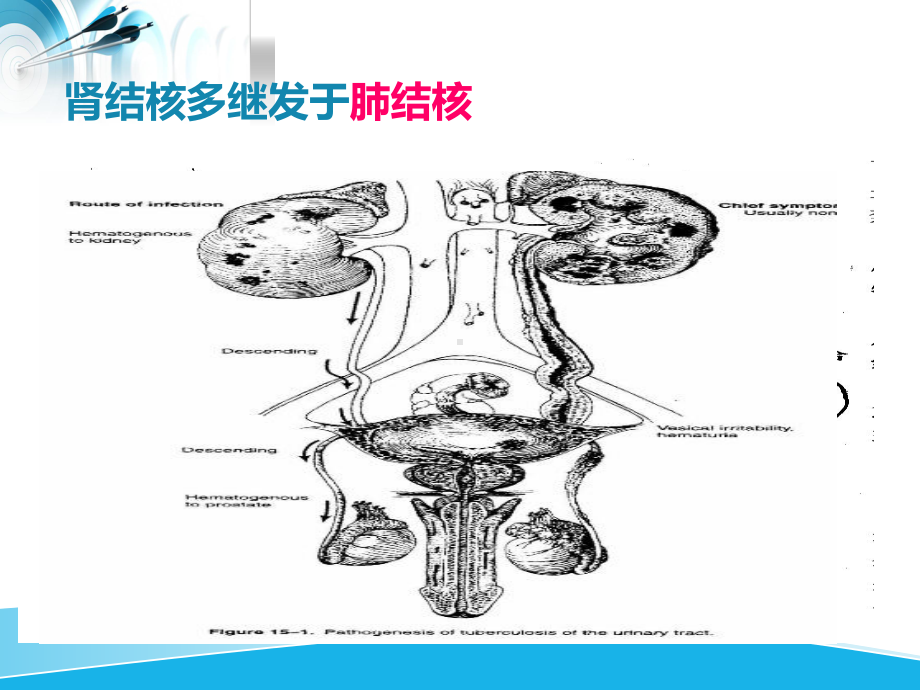 泌尿及男生殖系结核病人的护理-课件.ppt_第3页