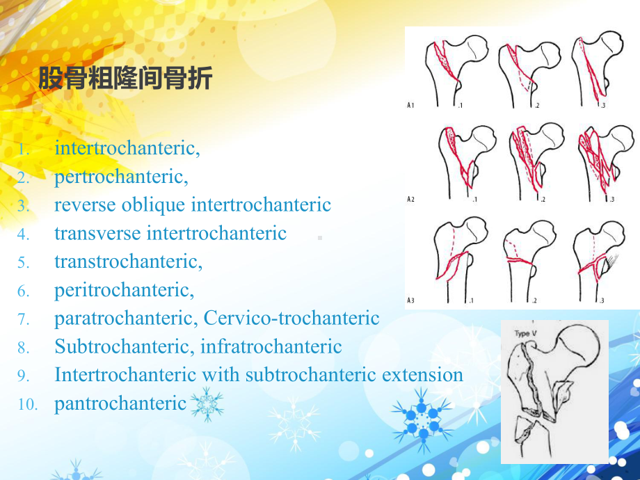 股骨粗隆间骨折的治疗进展-课件.ppt_第2页