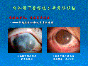 眼表病与角膜病四课件.ppt