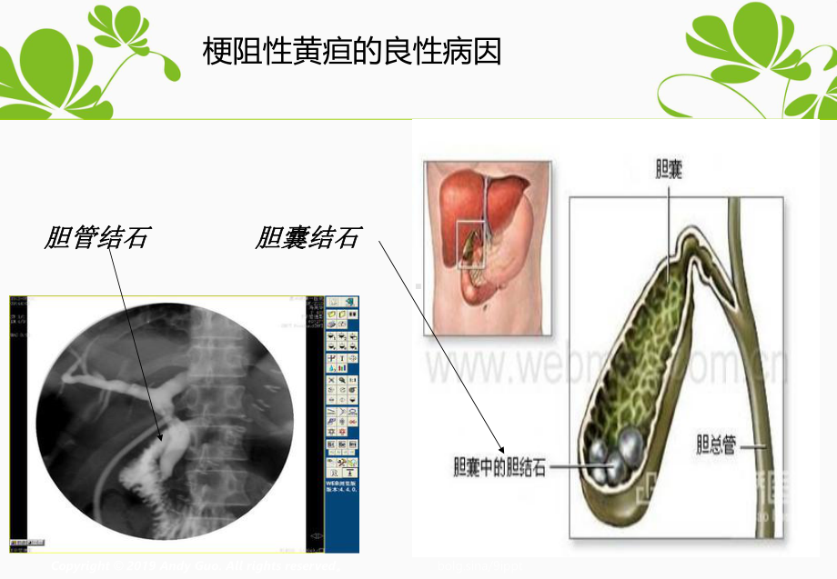 梗阻性黄疸护理查房1课件.ppt_第3页