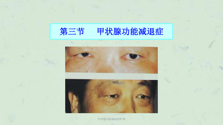 甲状腺功能减退的护理课件.ppt_第1页