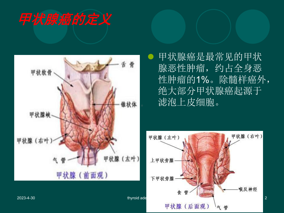 甲状腺肿瘤护理查房-课件.ppt_第2页