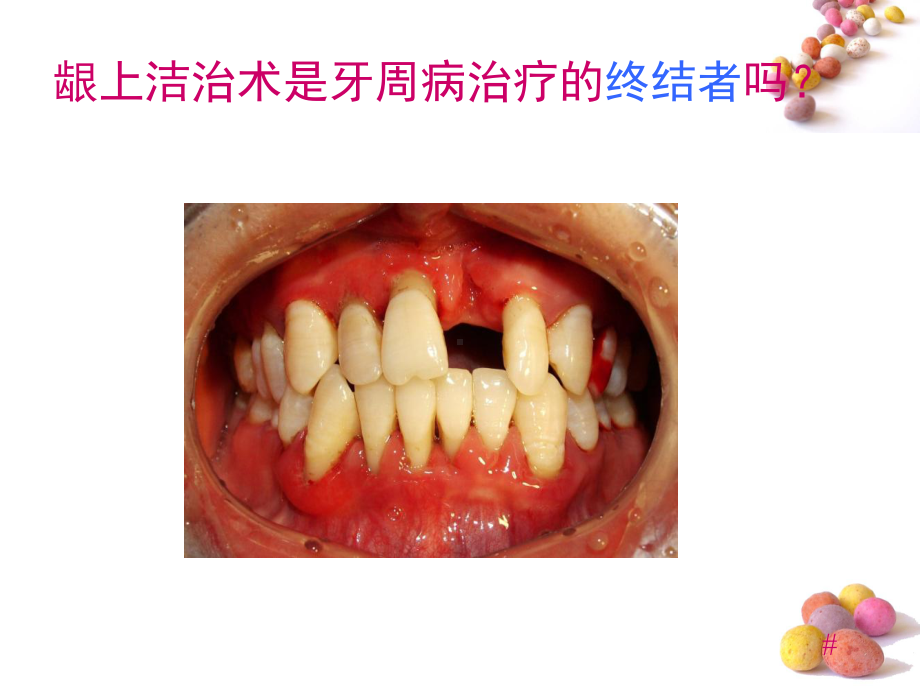 龈下刮治术1课件.pptx_第2页