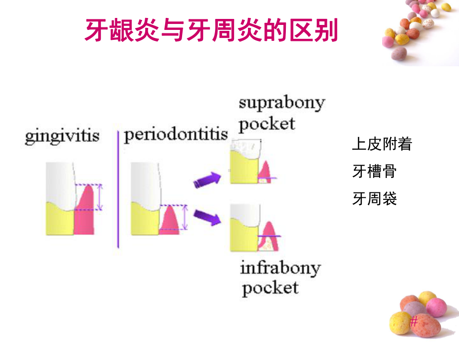 龈下刮治术1课件.pptx_第3页