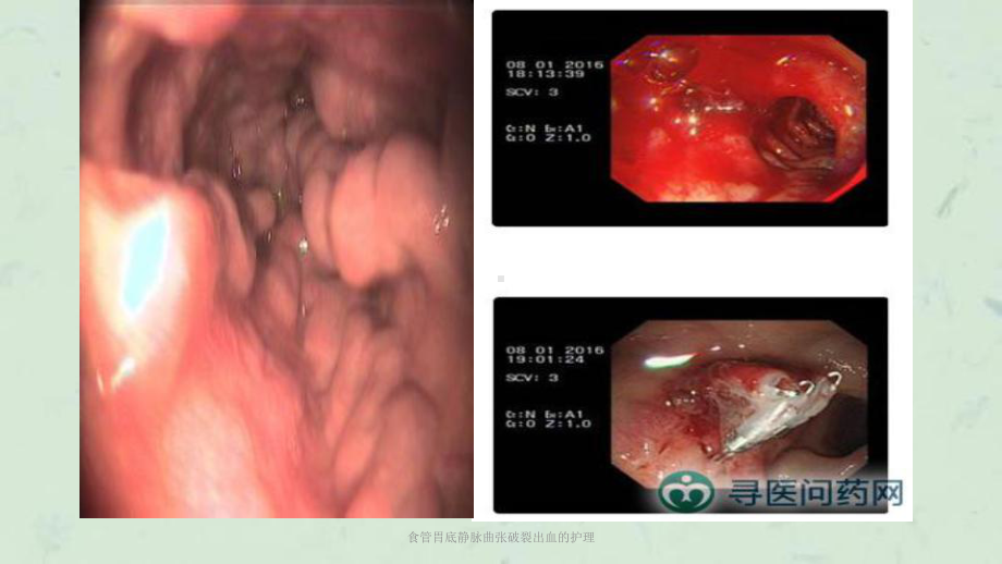 食管胃底静脉曲张破裂出血的护理课件.ppt_第3页