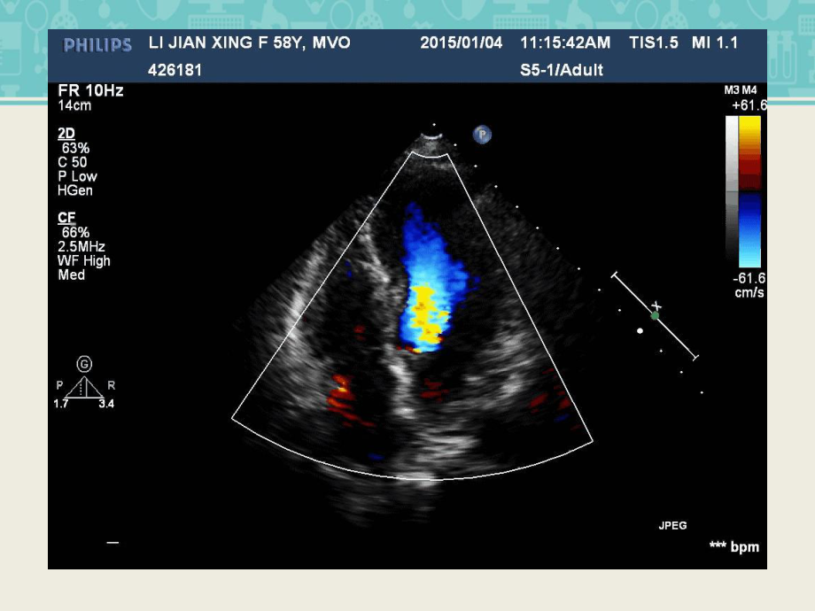 左室腔中部梗阻的超声心动图诊断课件.ppt_第2页