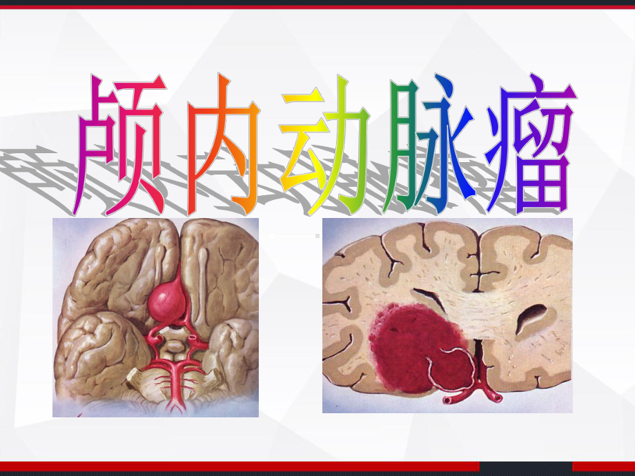 颅内动脉瘤介入术后的护理-课件.ppt_第1页