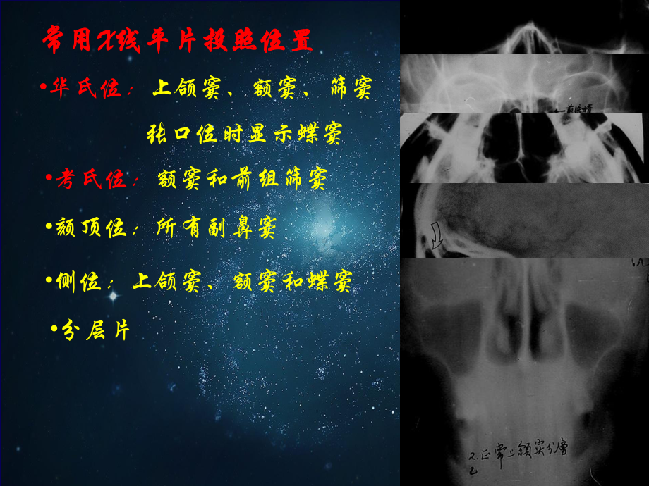 鼻和副鼻窦肿瘤影像诊断-课件.ppt_第3页