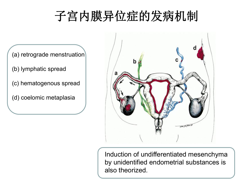 深部浸润型子宫内膜异位症的诊疗讲义课件.ppt_第2页