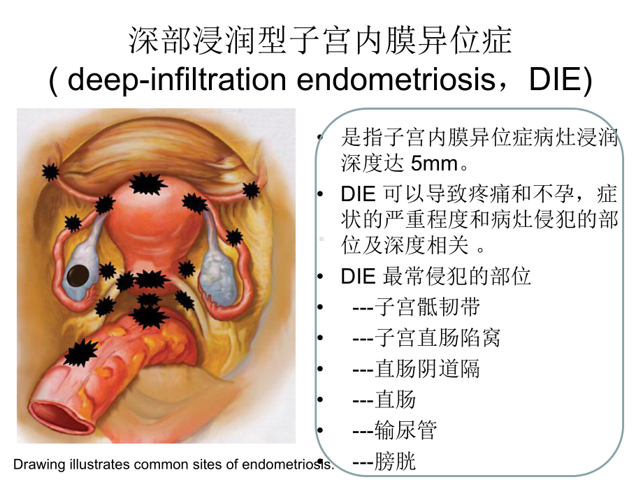 深部浸润型子宫内膜异位症的诊疗讲义课件.ppt_第3页