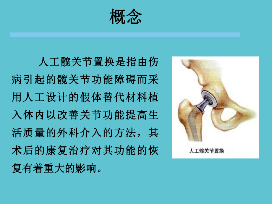 髋关节置换术后康复护理资料课件.pptx_第2页