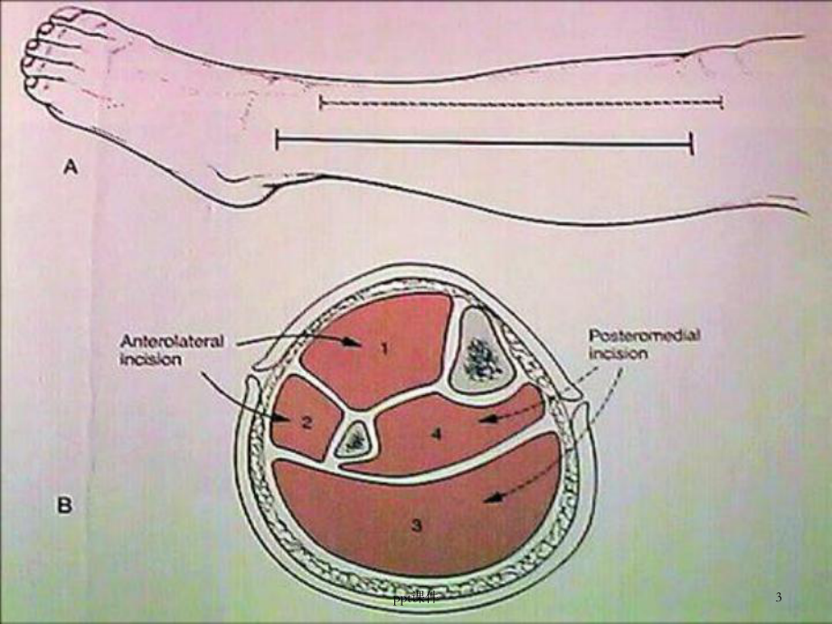 骨筋膜室综合征的观察与护理-课件.ppt_第3页