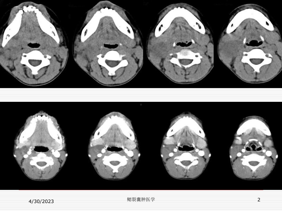 鳃裂囊肿医学培训课件.ppt_第2页