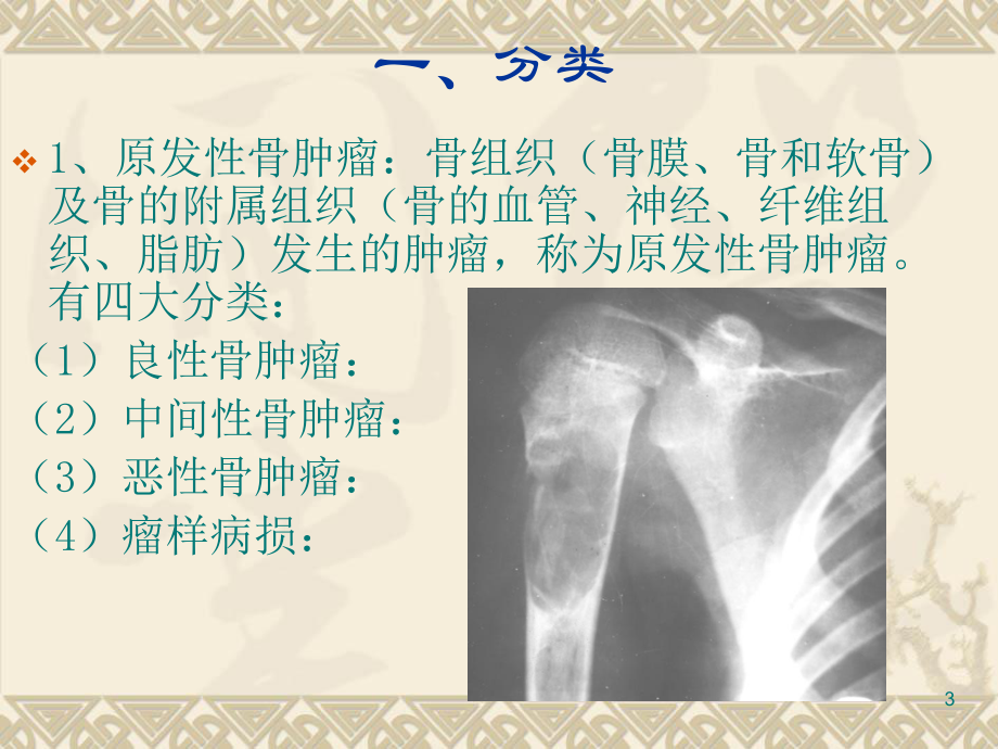 骨肿瘤病人的护理优秀课件.ppt_第3页