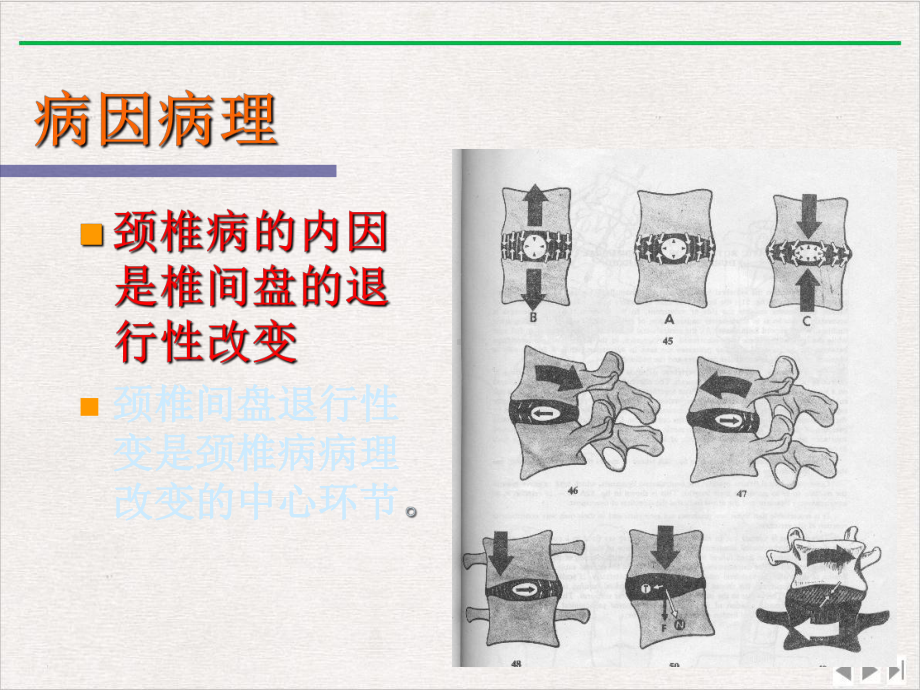 颈椎病推拿治疗优质版课件.pptx_第3页