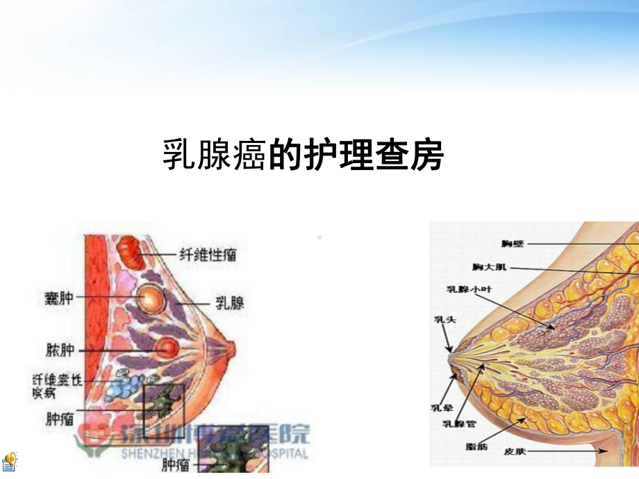 乳腺癌的护理查房-课件.ppt_第1页