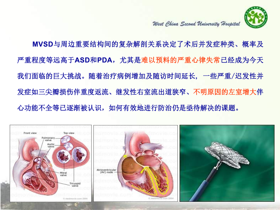 儿童室间隔缺损介入治疗挑课件.ppt_第2页