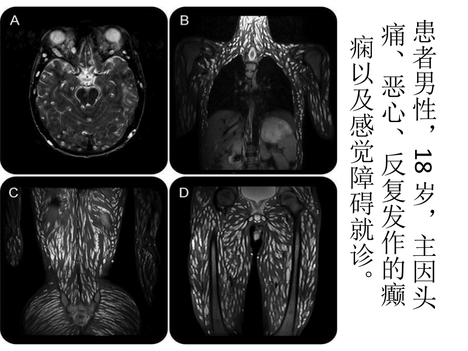 传染病学：囊尾蚴病课件.pptx_第1页