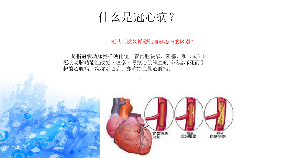 PCI术前术后护理课件.ppt_第2页