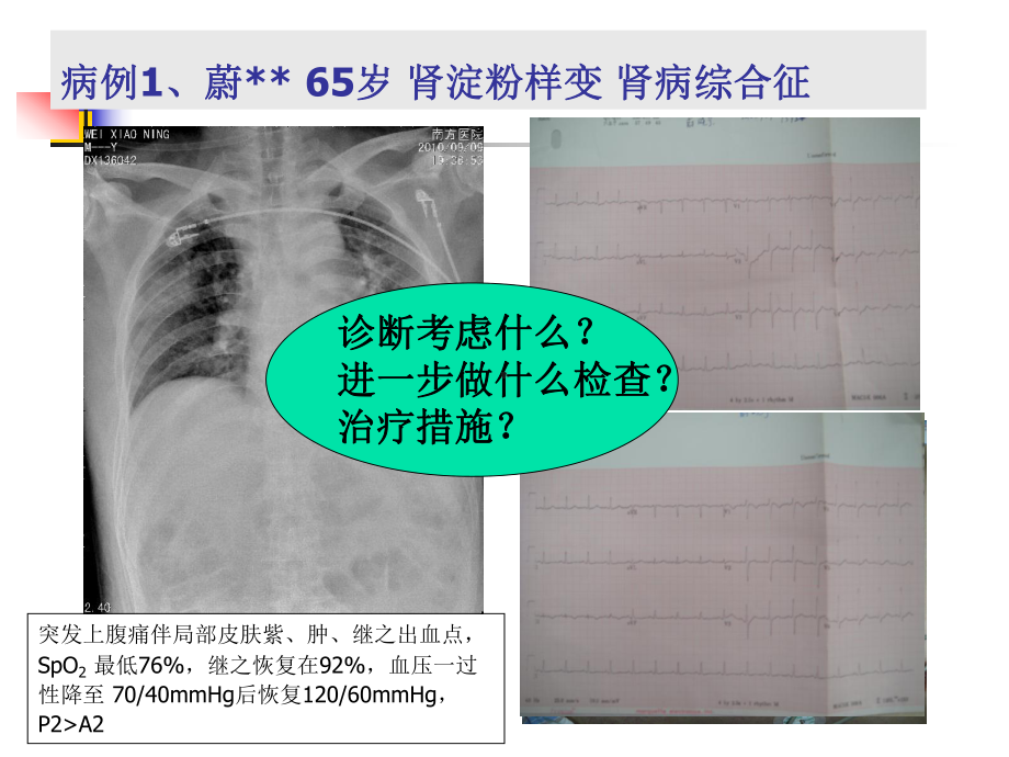 内科学课件：19-肺栓塞.ppt_第2页