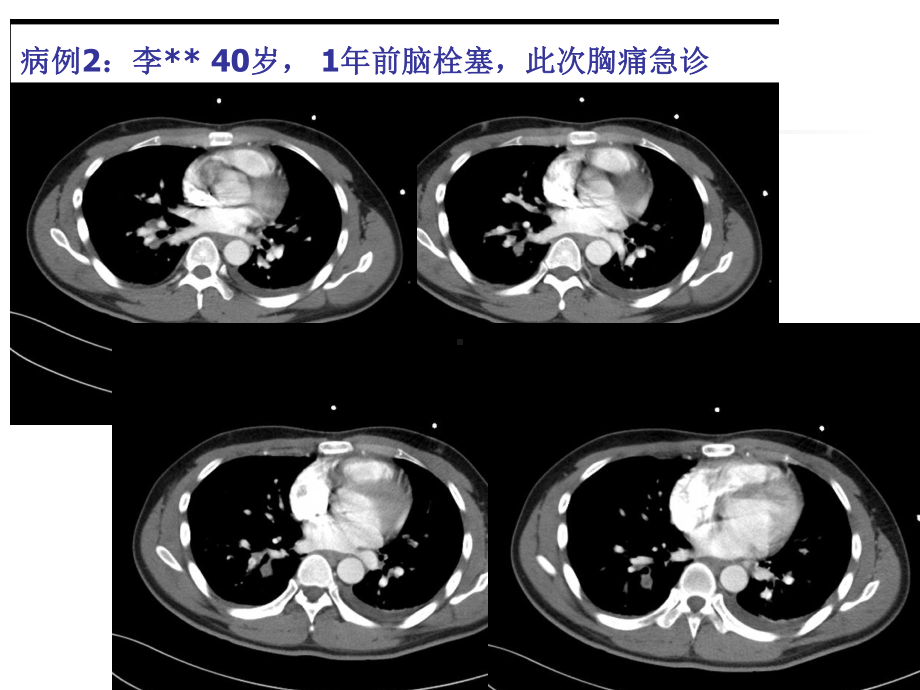 内科学课件：19-肺栓塞.ppt_第3页