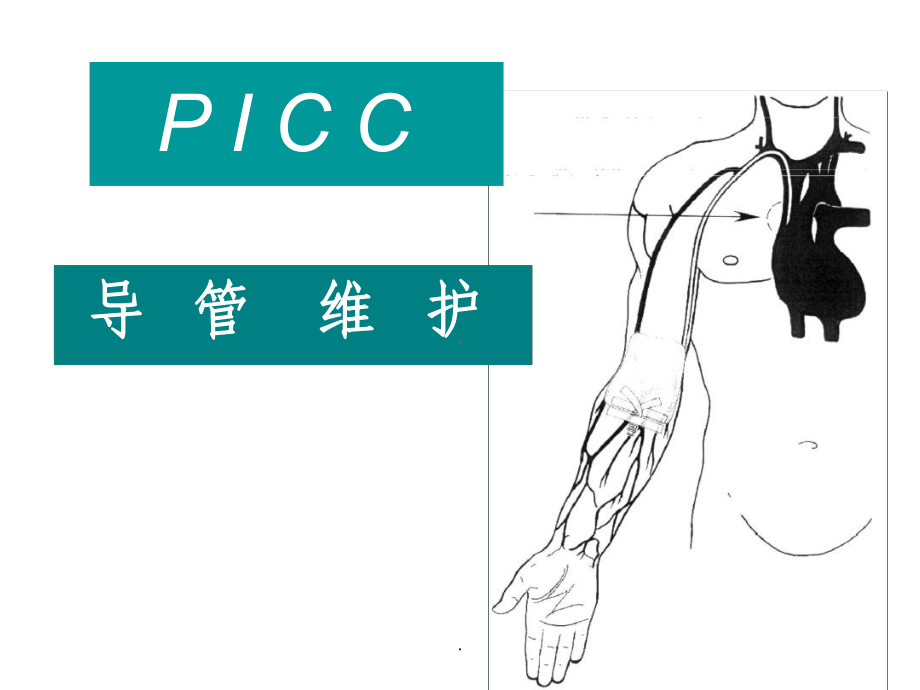 PICC导管维护最新课件.ppt_第1页