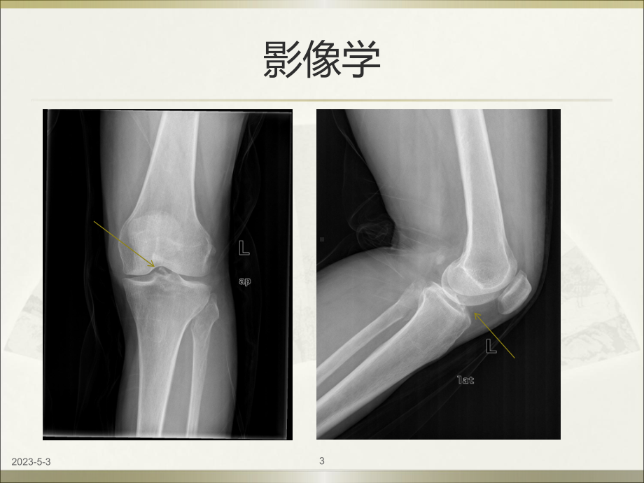 前交叉韧带胫骨止点撕脱性骨折教学课件.ppt_第3页