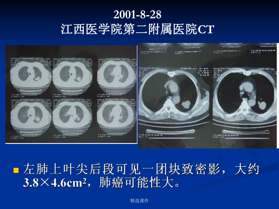 中医治疗肿瘤新策略-以肺癌为例-医学课件.ppt_第3页