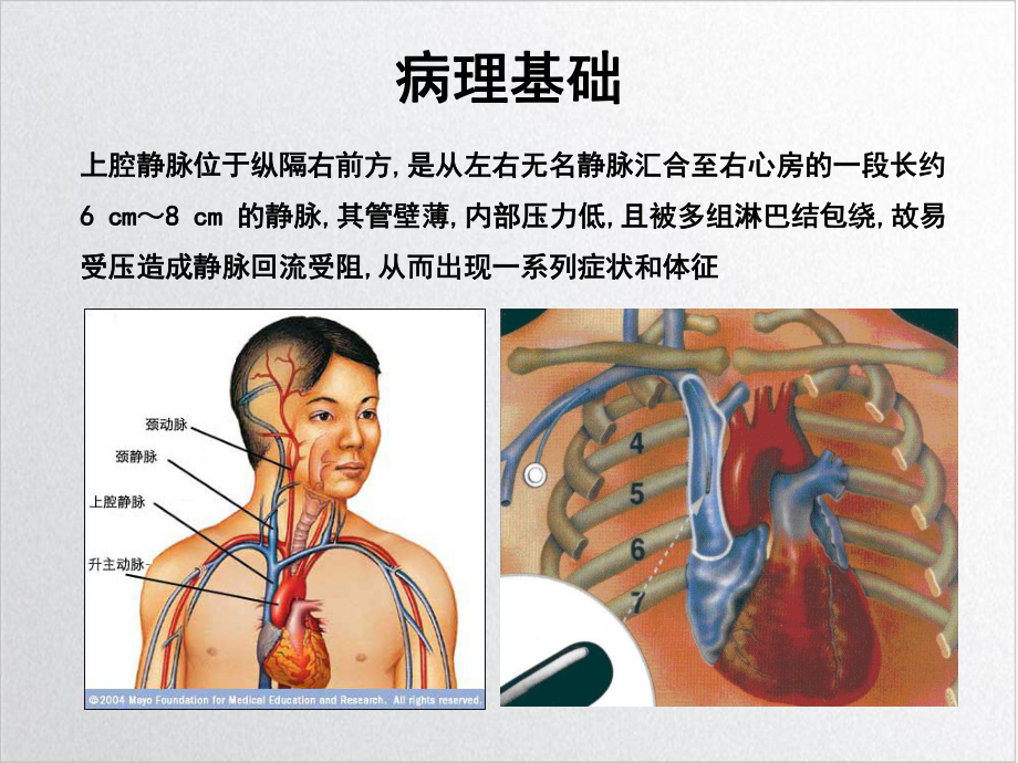 上腔静脉综合征护理查房实用课件.ppt_第3页