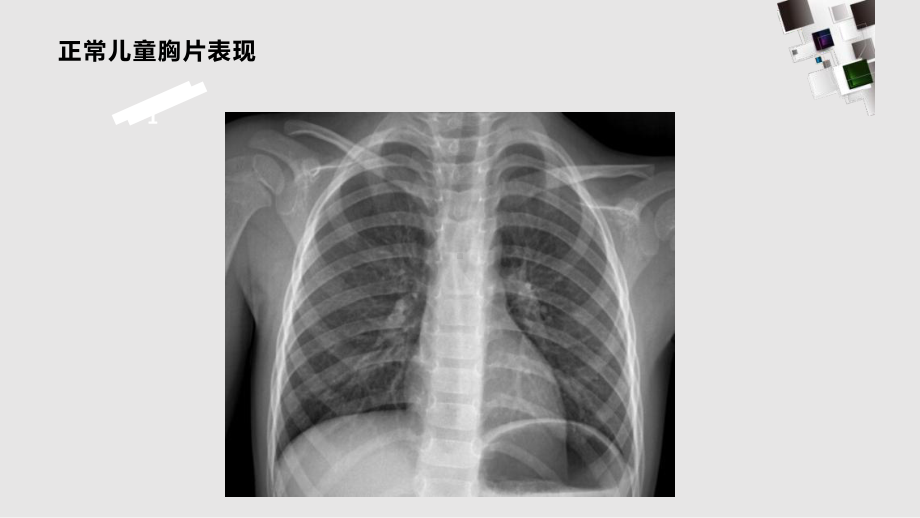 儿童常见肺部感染课件.pptx_第3页