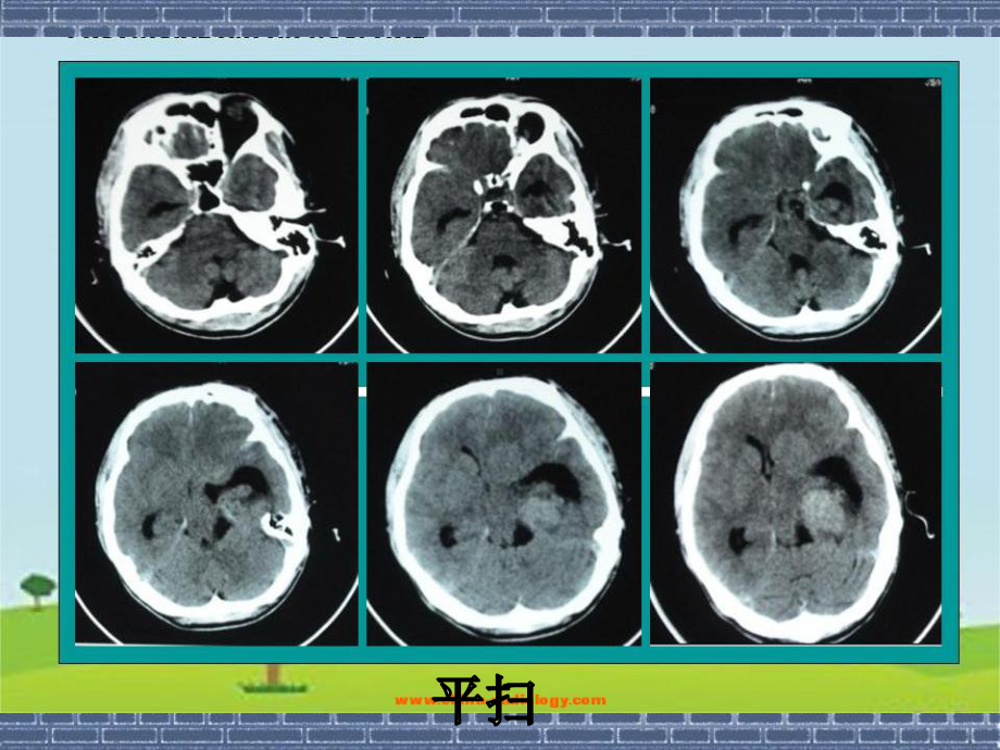 侧脑室脑膜瘤课件.ppt_第3页