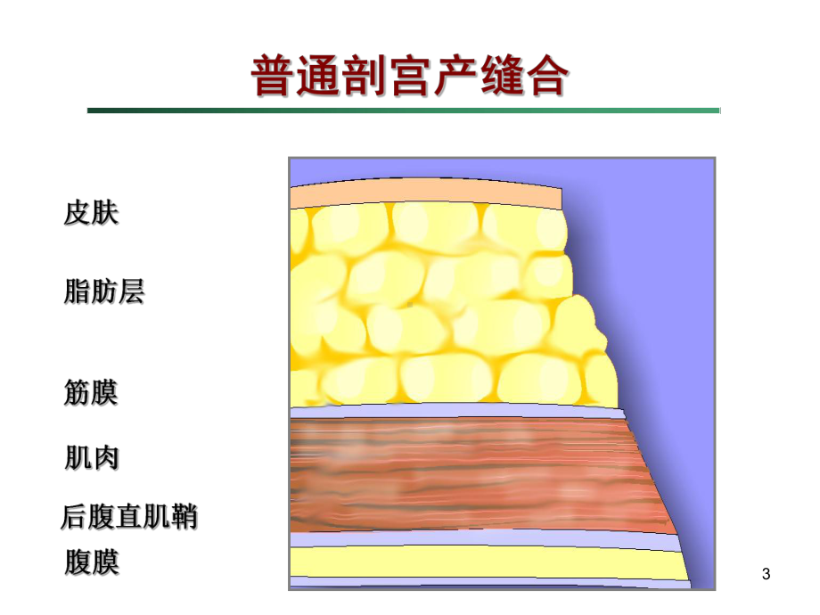 剖宫产手术缝合技术教学课件.ppt_第3页